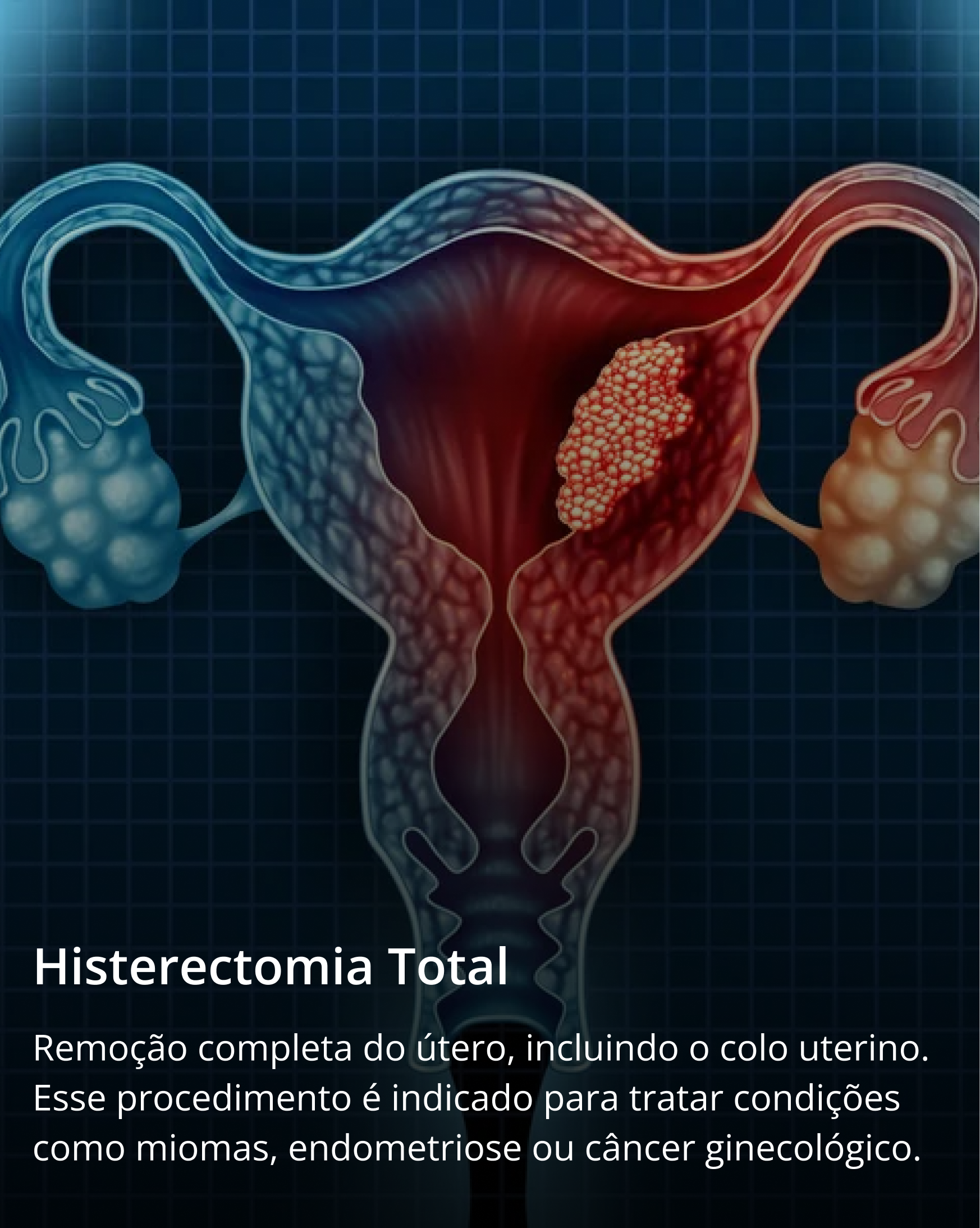 Histerectomia Total