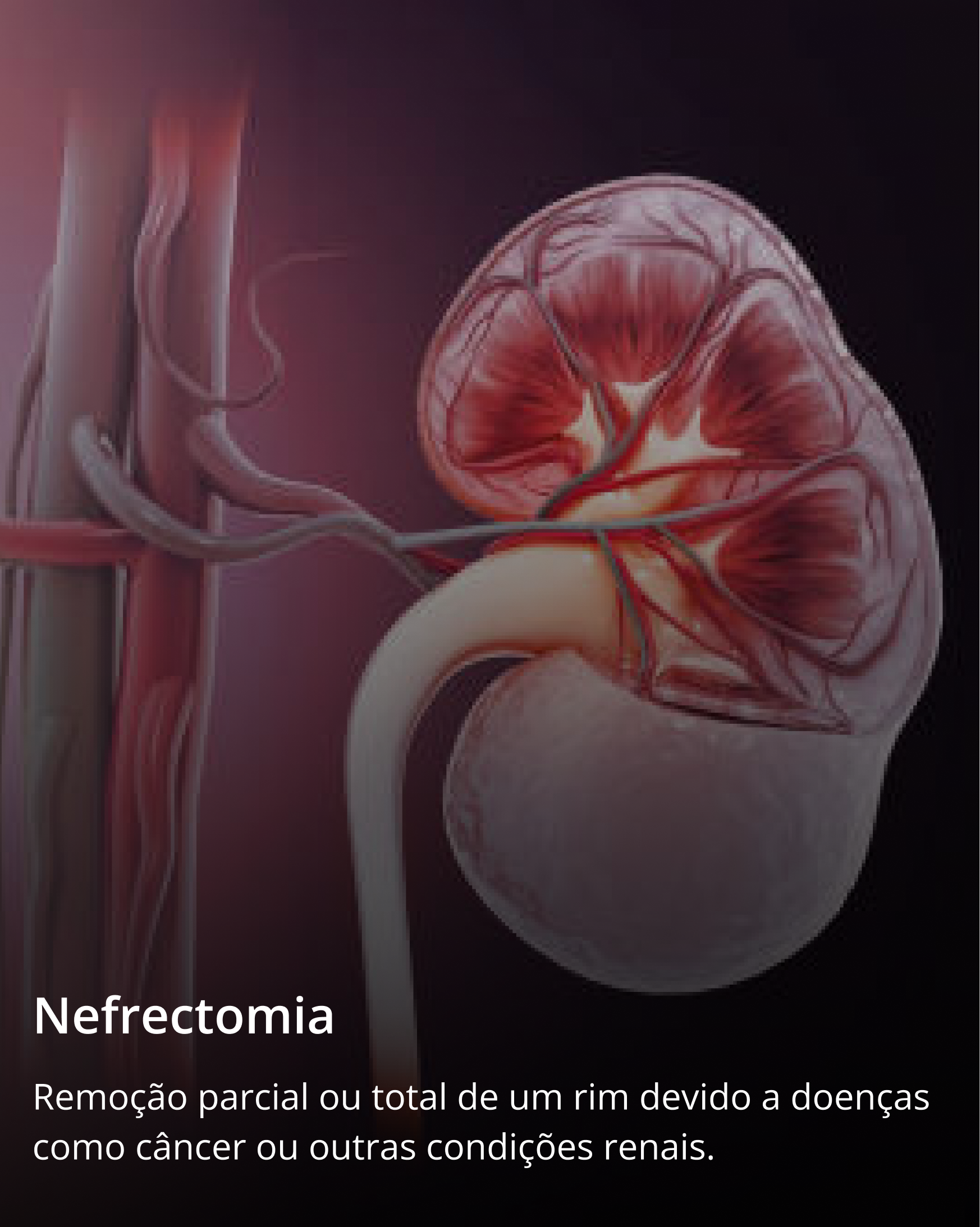 Nefrectomia