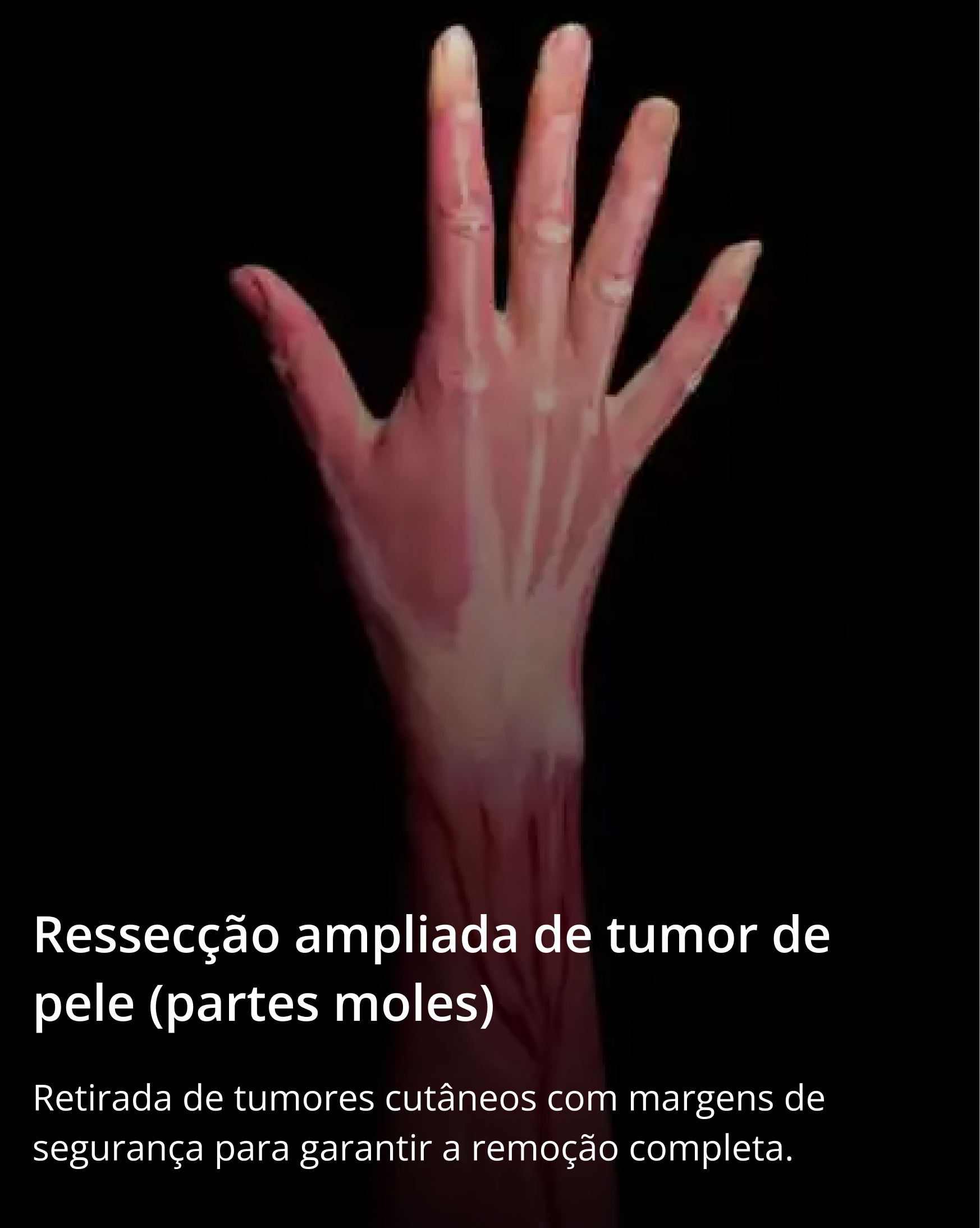 Ressecção ampliada de tumor de pele (partes moles)