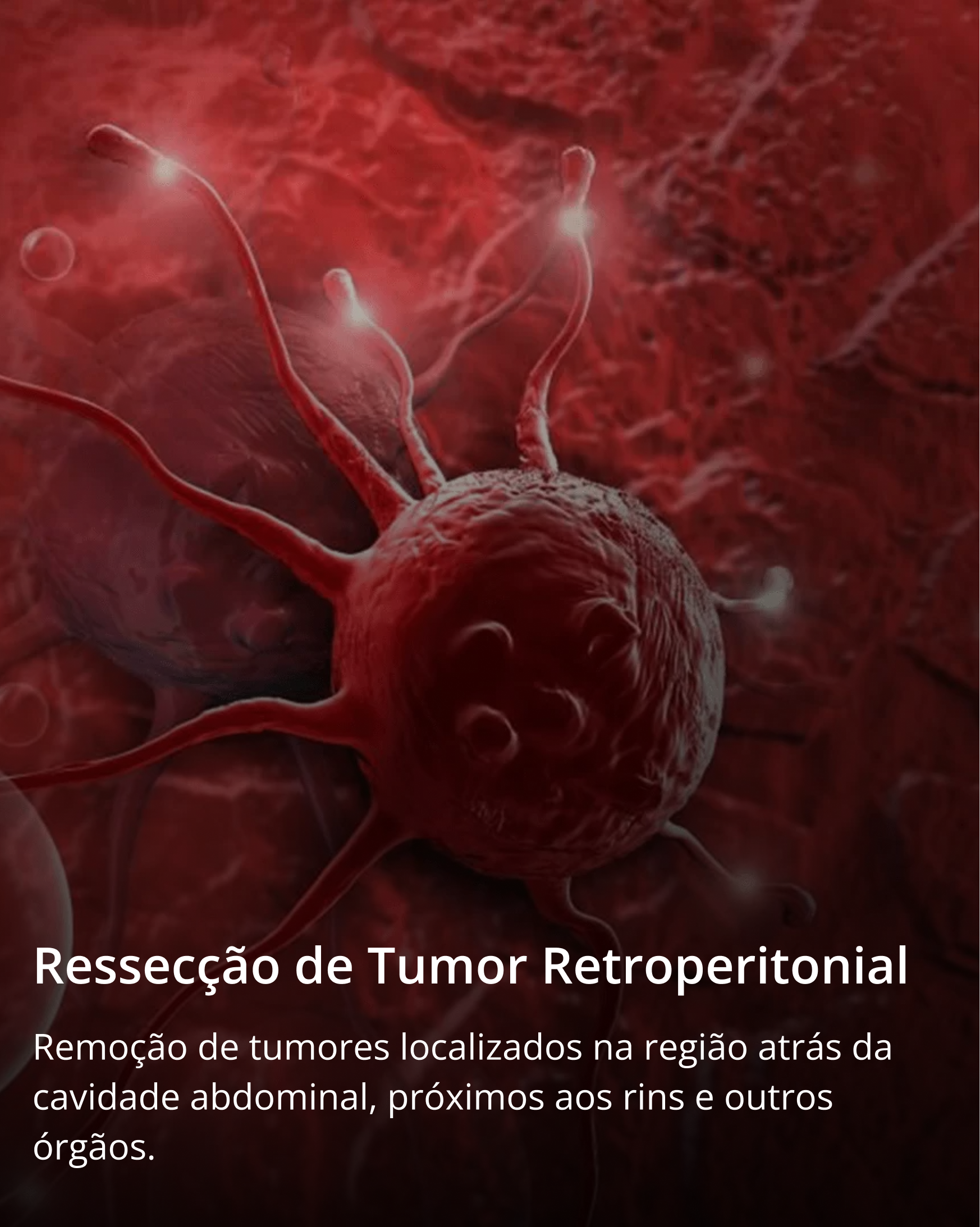 Ressecção de Tumor Retroperitonial